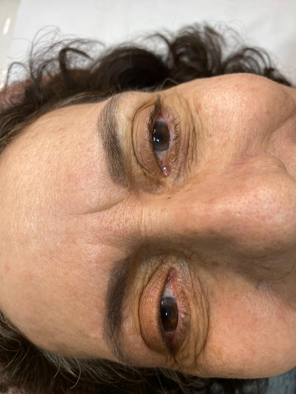 Lifting Labial